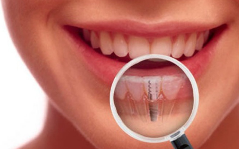 Dental Implants in Vasant Kunj