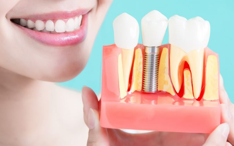 Best Dental Implants in Vasant Kunj