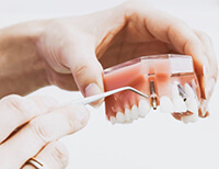 Importance of Dental Implants for Better Oral Health