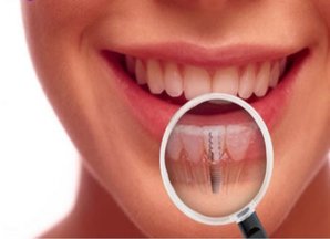 Dental Implants in South Delhi