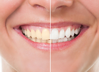 teeth whitening in South Delhi